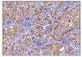 IHC staining of FFPE human gallbladder adenocarcinoma tissue with Deoxyhypusine synthase antibody. HIER: boil tissue sections in pH8 EDTA for 20 min and allow to cool before testing.