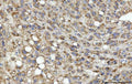 IHC staining of FFPE human liver cancer tissue with SEPT9 antibody. HIER: boil tissue sections in pH8 EDTA for 20 min and allow to cool before testing.
