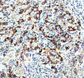 IHC staining of FFPE human stomach cancer tissue with DGAT1 antibody, HRP-secondary and DAB substrate. HIER: boil tissue sections in pH8 EDTA for 20 min and allow to cool before testing.