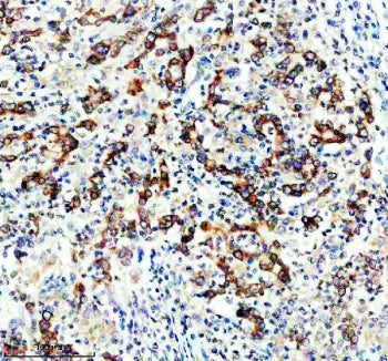 IHC staining of FFPE human stomach cancer tissue with DGAT1 antibody, HRP-secondary and DAB substrate. HIER: boil tissue sections in pH8 EDTA for 20 min and allow to cool before testing.