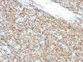 IHC staining of FFPE Ewings sarcoma tissue with CD99 antibody (clone 12E7). HIER: boil tissue sections in pH 9 10mM Tris with 1mM EDTA for 20 min and allow to cool before testing.