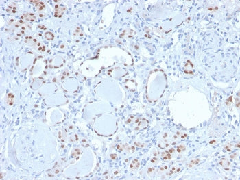 IHC staining of FFPE human kidney with recombinant PAX8 antibody. HIER: boil tissue sections in pH 9 10mM Tris with 1mM EDTA for 20 min and allow to cool before testing.
