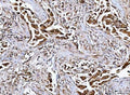 IHC staining of FFPE human breast cancer tissue with MFAP3 antibody. HIER: boil tissue sections in pH8 EDTA for 20 min and allow to cool before testing.