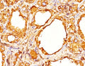 IHC staining of human thyroid tissue with Thyroglobulin antibody cocktail (clones 2H11 + 6E1).