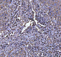 IHC staining of FFPE human squamous cell cervical carcinoma tissue with NLRP3 antibody. HIER: boil tissue sections in pH8 EDTA for 20 min and allow to cool before testing.