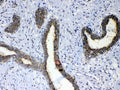 IHC testing of FFPE human breast cancer tissue with ERBB4 antibody at 1ug/ml. Required HIER: steam section in pH6 citrate buffer for 20 min and allow to cool prior to testing.