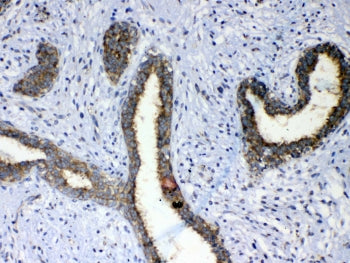 IHC testing of FFPE human breast cancer tissue with ERBB4 antibody at 1ug/ml. Required HIER: steam section in pH6 citrate buffer for 20 min and allow to cool prior to testing.