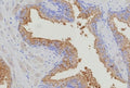 IHC staining of FFPE human prostate carcinoma tissue with recombinant Thymidylate Synthase antibody (clone TYMS/9091R). HIER: boil tissue sections in pH 9 10mM Tris with 1mM EDTA for 20 min and allow to cool before testing.