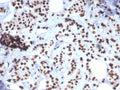 IHC staining of FFPE human breast carcinoma tissue with Heat shock 70 kDa protein 1B antibody (clone HSPA1B/7627). HIER: boil tissue sections in pH 9 10mM Tris with 1mM EDTA for 20 min and allow to cool before testing.