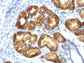 IHC: Formalin-fixed, paraffin-embedded human gastric carcinoma stained with MUC6 antibody (clone CLH5). HIER: steam section in pH6 citrate buffer for 20 min and allow to cool prior to testing.