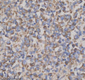 Immunohistochemical staining of GFRA2 using anti-GFRA2 antibody. GFRA2 was detected in a paraffin-embedded section of human thyroid cancer tissue. Heat mediated antigen retrieval was performed in EDTA buffer (pH 8.0, epitope retrieval solution). The tissue section was blocked with 10% goat serum. The tissue section was then incubated with 2 ug/ml rabbit anti-GFRA2 antibody overnight at 4oC. Peroxidase Conjugated Goat Anti-rabbit IgG was used as secondary antibody and incubated for 30 min at 37oC.
