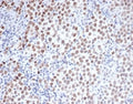 IHC staining of FFPE human seminoma with Oct4 antibody (clone Oct4/3508). HIER: boil tissue sections in pH 9 10mM Tris with 1mM EDTA for 20 min and allow to cool before testing.