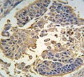 IHC analysis of FFPE human lung carcinoma tissue stained with RIPK3 antibody