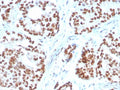IHC staining of FFPE human prostate carcinoma with NKX3.1 antibody. HIER: boil tissue sections in pH 9 10mM Tris with 1mM EDTA for 20 min and allow to cool before testing.