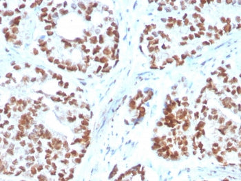 IHC staining of FFPE human prostate carcinoma with NKX3.1 antibody. HIER: boil tissue sections in pH 9 10mM Tris with 1mM EDTA for 20 min and allow to cool before testing.