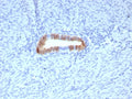 IHC staining of FFPE human cervical carcinoma tissue with P16INK4a antibody (clone rCDKN2A/8062). HIER: boil tissue sections in pH 9 10mM Tris with 1mM EDTA for 20 min and allow to cool before testing.