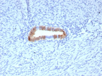 IHC staining of FFPE human cervical carcinoma tissue with P16INK4a antibody (clone rCDKN2A/8062). HIER: boil tissue sections in pH 9 10mM Tris with 1mM EDTA for 20 min and allow to cool before testing.