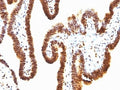 IHC: Formalin-fixed, paraffin-embedded human ovarian carcinoma stained with anti-SUMO-1 antibody (clone SPM571).