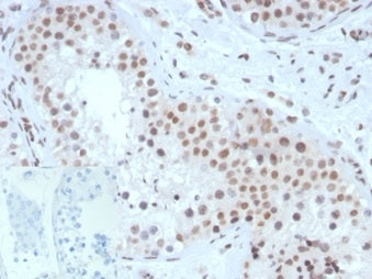 IHC staining of FFPE human testis tissue with SF-1 antibody (clone NR5A1/3420) at 2ug/ml. Negative control inset: PBS instead of primary antibody to control for secondary binding. HIER: boil tissue sections in pH 9 10mM Tris with 1mM EDTA for 20 min and allow to cool before testing.