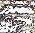 Immunohistochemical staining of FXN using anti-FXN antibody. FXN was detected in a paraffin-embedded section of human ovarian cancer tissue. Heat mediated antigen retrieval was performed in EDTA buffer (pH 8.0, epitope retrieval solution). The tissue section was blocked with 10% goat serum. The tissue section was then incubated with 2 ug/ml rabbit anti-FXN antibody overnight at 4oC. Peroxidase Conjugated Goat Anti-rabbit IgG was used as secondary antibody and incubated for 30 minutes at 37oC. The tissue sec