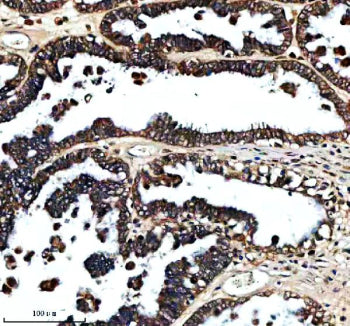 Immunohistochemical staining of FXN using anti-FXN antibody. FXN was detected in a paraffin-embedded section of human ovarian cancer tissue. Heat mediated antigen retrieval was performed in EDTA buffer (pH 8.0, epitope retrieval solution). The tissue section was blocked with 10% goat serum. The tissue section was then incubated with 2 ug/ml rabbit anti-FXN antibody overnight at 4oC. Peroxidase Conjugated Goat Anti-rabbit IgG was used as secondary antibody and incubated for 30 minutes at 37oC. The tissue sec