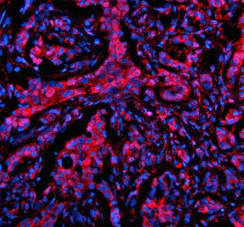 Immunofluorescent staining of MTMR3 using anti-MTMR3 antibody (green) and anti-Beta Tubulin antibody (red). MTMR3 was detected in an immunocytochemical section of SIHA cells. Enzyme antigen retrieval was performed using IHC enzyme antigen retrieval reagent for 15 mins. The cells were blocked with 10% goat serum. And then incubated with 5 ug/ml rabbit anti-MTMR3 antibody and mouse anti-Beta Tubulin antibody overnight at 4oC.