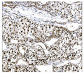 IHC staining of FFPE human liver cancer tissue with EHMT2 antibody. HIER: boil tissue sections in pH8 EDTA for 20 min and allow to cool before testing.