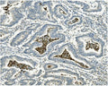 IHC staining of FFPE human rectal cancer with ATG4A antibody. HIER: boil tissue sections in pH8 EDTA for 20 min and allow to cool before testing.