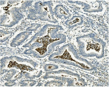 IHC staining of FFPE human rectal cancer with ATG4A antibody. HIER: boil tissue sections in pH8 EDTA for 20 min and allow to cool before testing.