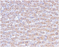 IHC staining of FFPE human liver carcinoma in colon tissue with CD40L antibody (clone CD40LG/4675) at 2ug/ml. HIER: boil tissue sections in pH 9 10mM Tris with 1mM EDTA for 20 min and allow to cool before testing.