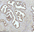 Immunohistochemical staining of IGFL3 using anti-IGFL3 antibody. IGFL3 was detected in a paraffin-embedded section of human prostate cancer tissue. Heat mediated antigen retrieval was performed in EDTA buffer (pH 8.0, epitope retrieval solution). The tissue section was blocked with 10% goat serum. The tissue section was then incubated with 2 ug/ml rabbit anti-IGFL3 antibody overnight at 4oC. Peroxidase Conjugated Goat Anti-rabbit IgG was used as secondary antibody and incubated for 30 min at 37oC.