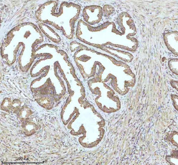 Immunohistochemical staining of IGFL3 using anti-IGFL3 antibody. IGFL3 was detected in a paraffin-embedded section of human prostate cancer tissue. Heat mediated antigen retrieval was performed in EDTA buffer (pH 8.0, epitope retrieval solution). The tissue section was blocked with 10% goat serum. The tissue section was then incubated with 2 ug/ml rabbit anti-IGFL3 antibody overnight at 4oC. Peroxidase Conjugated Goat Anti-rabbit IgG was used as secondary antibody and incubated for 30 min at 37oC.