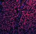 Immunofluorescent staining of FFPE human non-small cell carcinoma tissue with SP1 antibody (red) and DAPI nuclear stain (blue). HIER: steam section in pH8 EDTA buffer for 20 min.