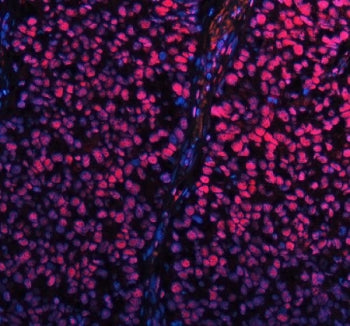 Immunofluorescent staining of FFPE human non-small cell carcinoma tissue with SP1 antibody (red) and DAPI nuclear stain (blue). HIER: steam section in pH8 EDTA buffer for 20 min.