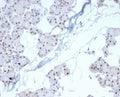 IHC staining of FFPE human renal cell carcinoma with recombinant PHOX2B antibody (clone PHOX2B/7161R). HIER: boil tissue sections in pH 9 10mM Tris with 1mM EDTA for 20 min and allow to cool before testing.