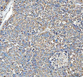 IHC staining of FFPE human liver cancer tissue with HSD11B1 antibody. HIER: boil tissue sections in pH8 EDTA for 20 min and allow to cool before testing.