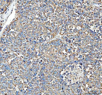 IHC staining of FFPE human liver cancer tissue with HSD11B1 antibody. HIER: boil tissue sections in pH8 EDTA for 20 min and allow to cool before testing.