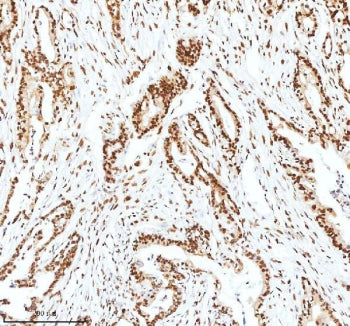 IHC staining of FFPE human pancreas ductal adenocarcinoma tissue with Ku70 antibody. HIER: boil tissue sections in pH8 EDTA for 20 min and allow to cool before testing.