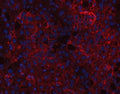 Immunofluorescent staining of FFPE human liver cancer tissue with CD166 antibody (red) and DAPI nuclear stain (blue). HIER: steam section in pH8 EDTA buffer for 20 min.