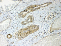 IHC testing of FFPE human lung cancer tissue with HSP22 antibody at 1ug/ml. Required HIER: steam section in pH6 citrate buffer for 20 min and allow to cool prior to testing.