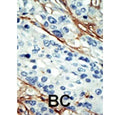 IHC staining of FFPE human breast cancer tissue with NUAK1 antibody. HIER: steam section in pH6 citrate buffer for 20 min and allow to cool prior to staining.