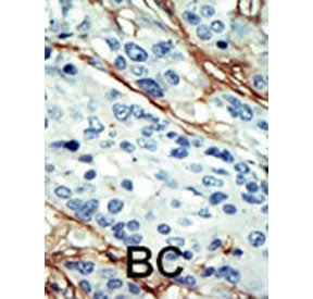 IHC staining of FFPE human breast cancer tissue with NUAK1 antibody. HIER: steam section in pH6 citrate buffer for 20 min and allow to cool prior to staining.