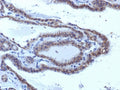 IHC testing of FFPE human thyroid carcinoma with TSHR antibody (clone SPM223). Required HIER: boil tissue sections in 10mM Tris with 1mM EDTA, pH 9, or 10mM citrate buffer, pH 6, for 10-20 min followed by cooling at RT for 20 min.