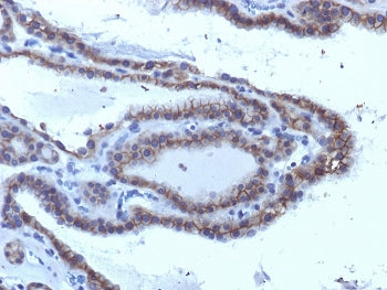 IHC testing of FFPE human thyroid carcinoma with TSHR antibody (clone SPM223). Required HIER: boil tissue sections in 10mM Tris with 1mM EDTA, pH 9, or 10mM citrate buffer, pH 6, for 10-20 min followed by cooling at RT for 20 min.