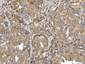 IHC staining of FFPE human thyroid papillary carcinoma tissue with Pyrin antibody. HIER: boil tissue sections in pH8 EDTA for 20 min and allow to cool before testing.