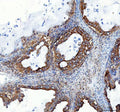 IHC staining of FFPE human ovarian serous adenocarcinoma tissue with Heme Oxygenase 2 antibody. HIER: boil tissue sections in pH8 EDTA buffer for 20 min and allow to cool before testing.