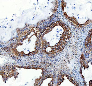 IHC staining of FFPE human ovarian serous adenocarcinoma tissue with Heme Oxygenase 2 antibody. HIER: boil tissue sections in pH8 EDTA buffer for 20 min and allow to cool before testing.