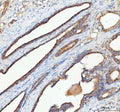 Immunohistochemical staining of RHOT2 using anti-RHOT2 antibody. RHOT2 was detected in a paraffin-embedded section of human prostate cancer tissue. Heat mediated antigen retrieval was performed in EDTA buffer (pH 8.0, epitope retrieval solution). The tissue section was blocked with 10% goat serum. The tissue section was then incubated with 2 ug/ml rabbit anti-RHOT2 antibody overnight at 4oC. Peroxidase Conjugated Goat Anti-rabbit IgG was used as secondary antibody and incubated for 30 min at 37oC.