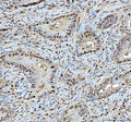 IHC staining of FFPE human rectum adenocarcinoma tissue with PSMA1 antibody. HIER: boil tissue sections in pH8 EDTA for 20 min and allow to cool before testing.
