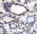 IHC analysis of TMED10 using anti-TMED10 antibody. TMED10 was detected in a paraffin-embedded section of human thyroid cancer tissue. Heat mediated antigen retrieval was performed in EDTA buffer (pH 8.0, epitope retrieval solution). The tissue section was blocked with 10% goat serum. The tissue section was then incubated with 2 ug/ml rabbit anti-TMED10 antibody overnight at 4oC. Peroxidase Conjugated Goat Anti-rabbit IgG was used as secondary antibody and incubated for 30 min at 37oC.